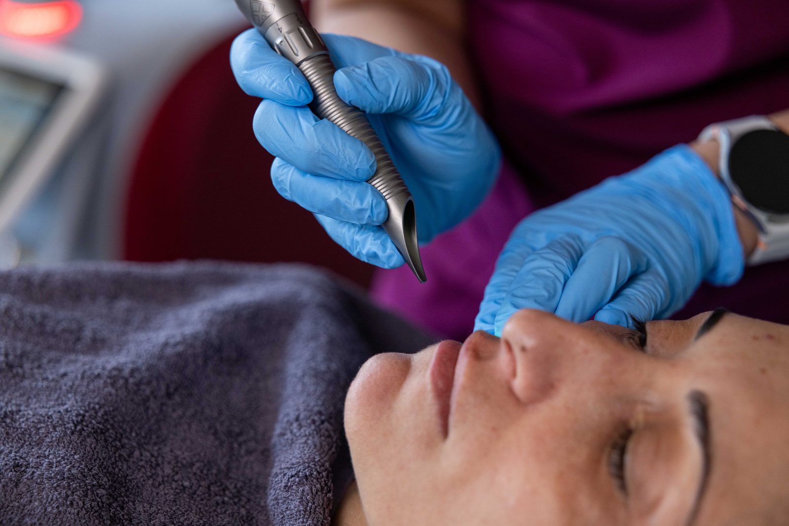 Trattamento laser Fotona sul viso
